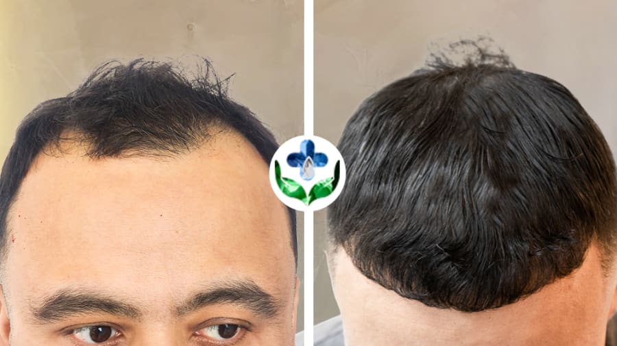 Trasplante capilar antes y después, restauración de línea capilar frontal — Colombia Care, Medellín