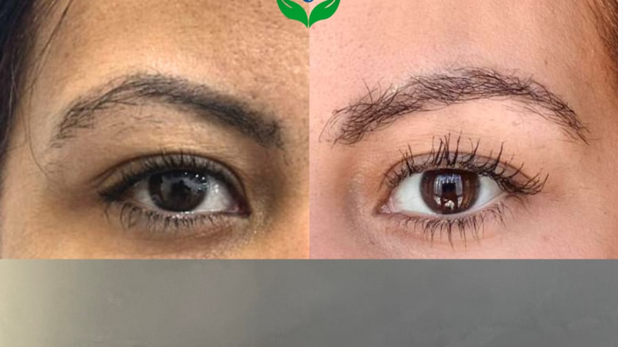 Antes y después de trasplante de cejas, cejas escasas, Chile Care