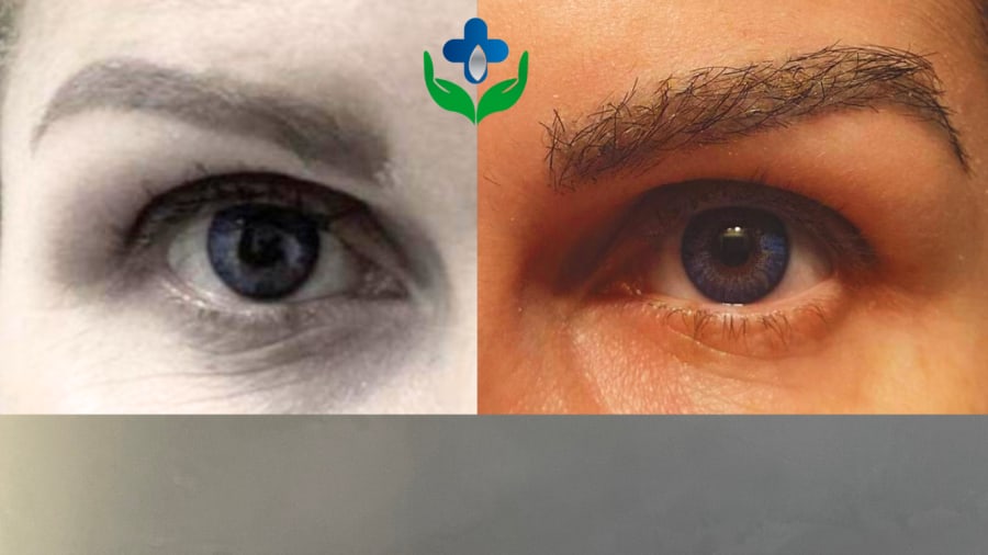Antes y después de trasplante de cejas, cejas sobredepiladas, Chile Care