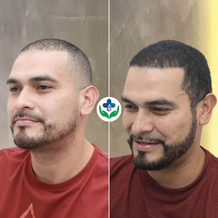 Beard transplant before and after, fuller cheeks and jawline — Colombia Care, Medellín