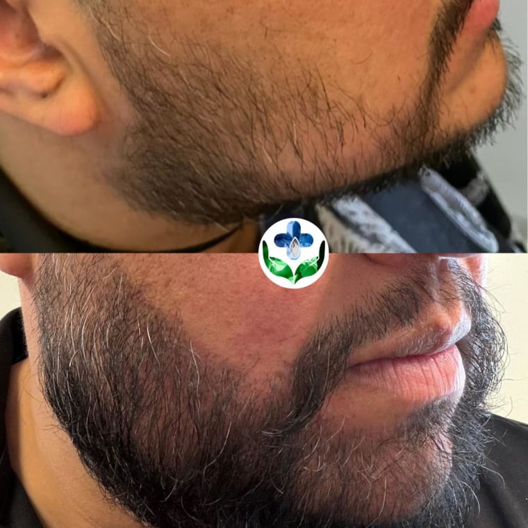 Beard transplant before and after, patchy growth filled in — Colombia Care, Medellín