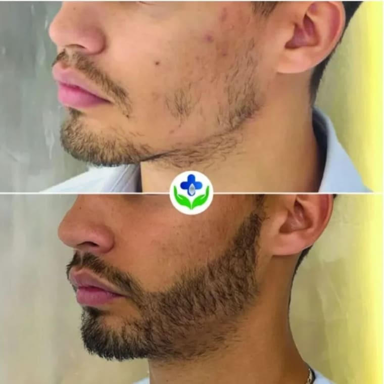 Beard transplant before and after, sparse beard built up — Colombia Care, Medellín