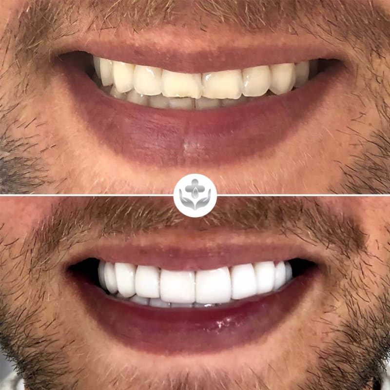 Antes y después de carillas de resina, dientes cortos alargados, Medellín, Colombia