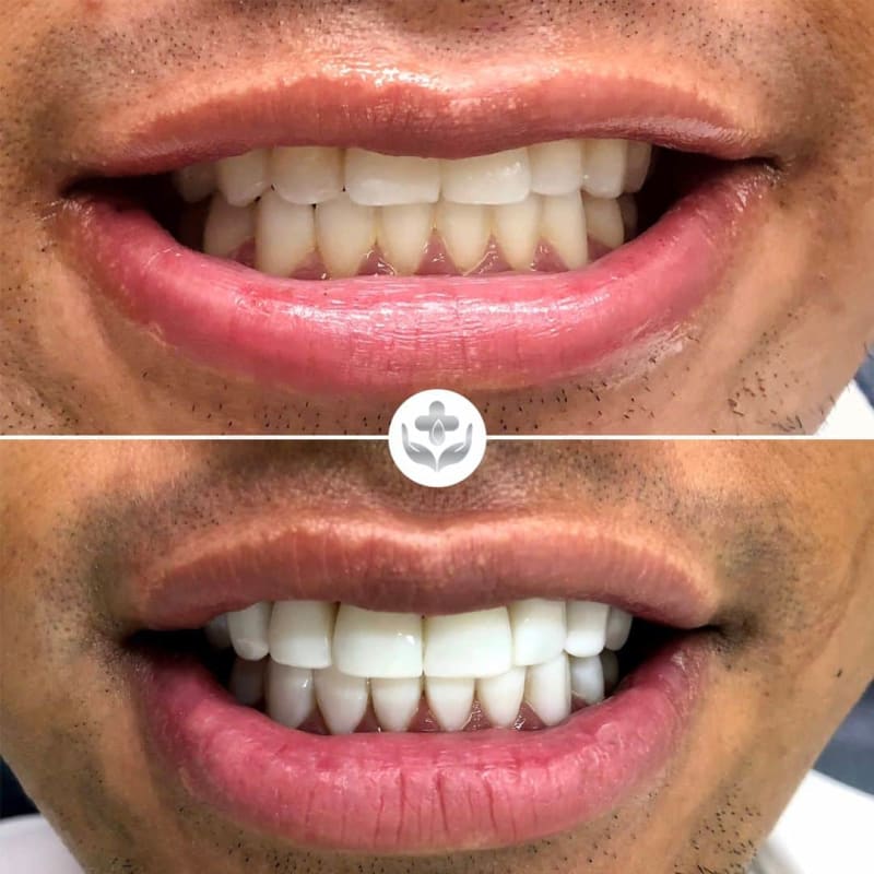 Antes y después de carillas de resina, dientes frontales astillados restaurados, Medellín, Colombia