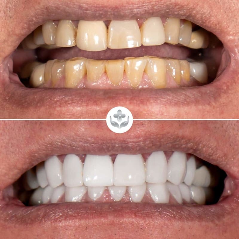 Antes y después de carillas de zirconio, arcada completa, Medellín, Colombia