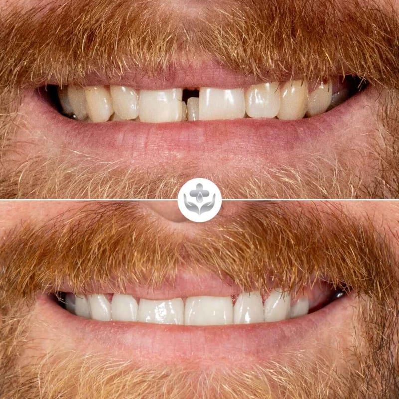 Antes y después de carillas de zirconio, rediseño con mordida fuerte, Medellín, Colombia