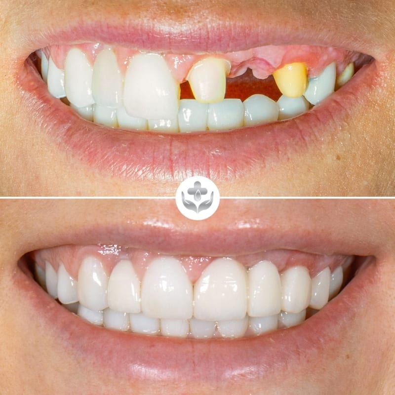 Antes y después de implante dental, reemplazo de diente anterior, Medellín, Colombia