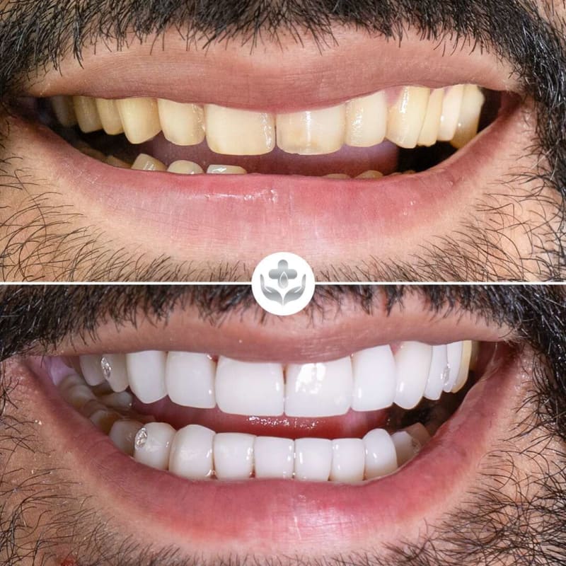 Porcelain veneers before and after, full smile makeover, Medellín, Colombia