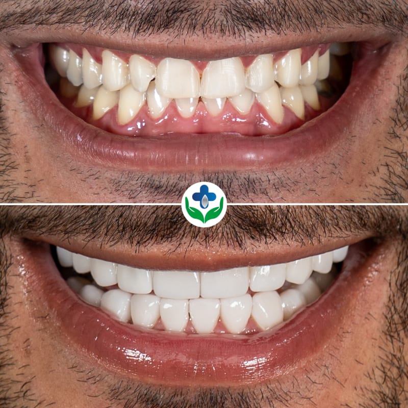 Antes y después de carillas de resina, caso de Anthony, Medellín, Colombia