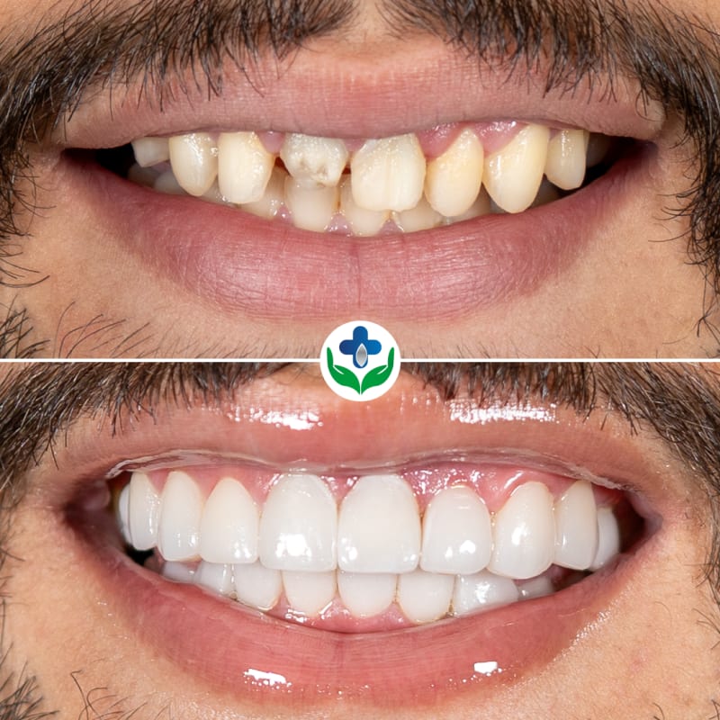 Porcelain veneers before and after, full smile redesign, Gabriel, Medellín, Colombia