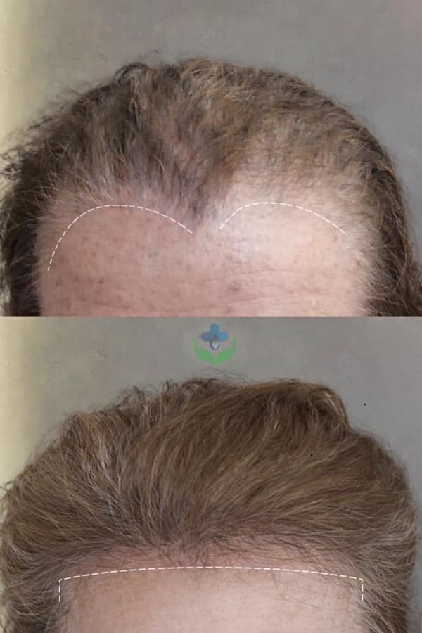 Antes y después de trasplante capilar femenino, línea frontal, Chile Care