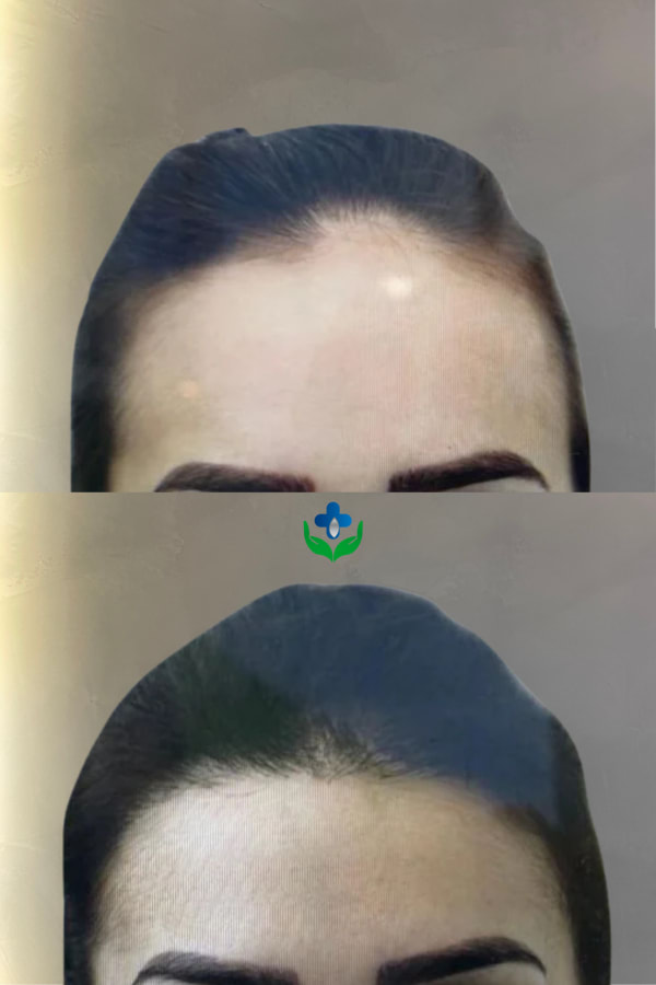 Antes y después de trasplante capilar femenino, línea frontal bajada, Chile Care