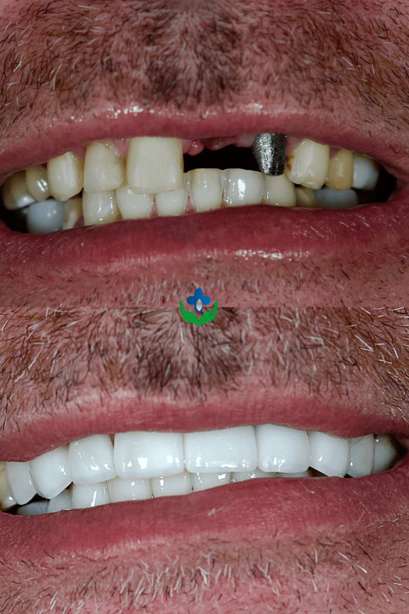 Before and after: missing front tooth and worn teeth restored to a full, even smile, Medellín, Colombia