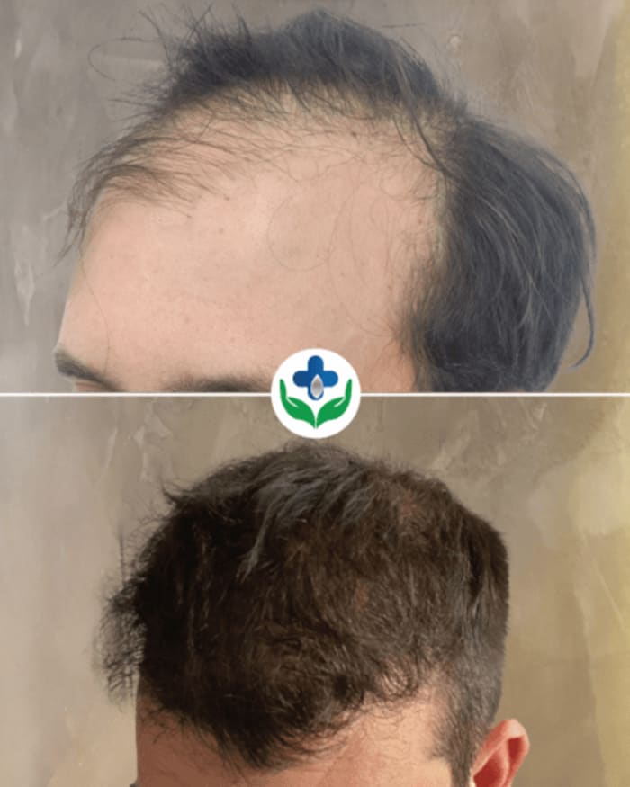 Trasplante capilar antes y después para adelgazamiento difuso — Colombia Care, Medellín