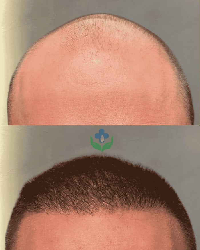 Trasplante capilar antes y después para densidad en la corona — Colombia Care, Medellín