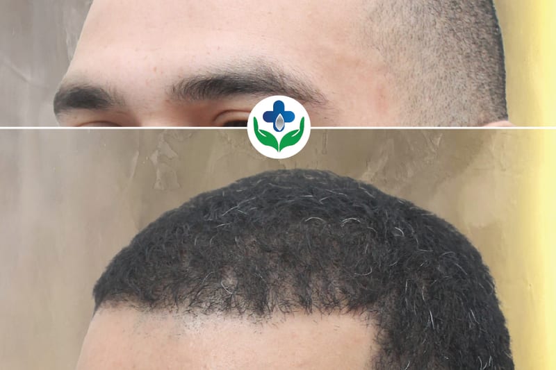Colombia Care hair transplant patient photographed at short clipper length, before and after