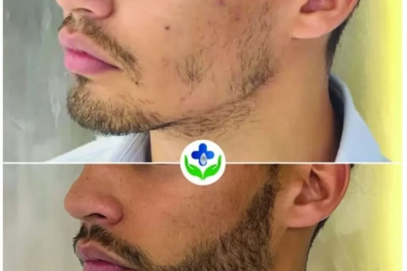 Implante de Barba en Santiago: Guía Completa FUE 2026
