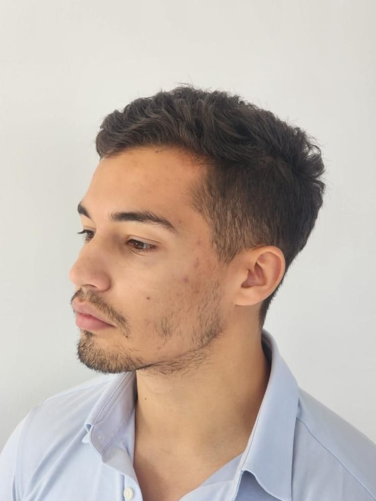 Gabriel's patchy beard before the transplant