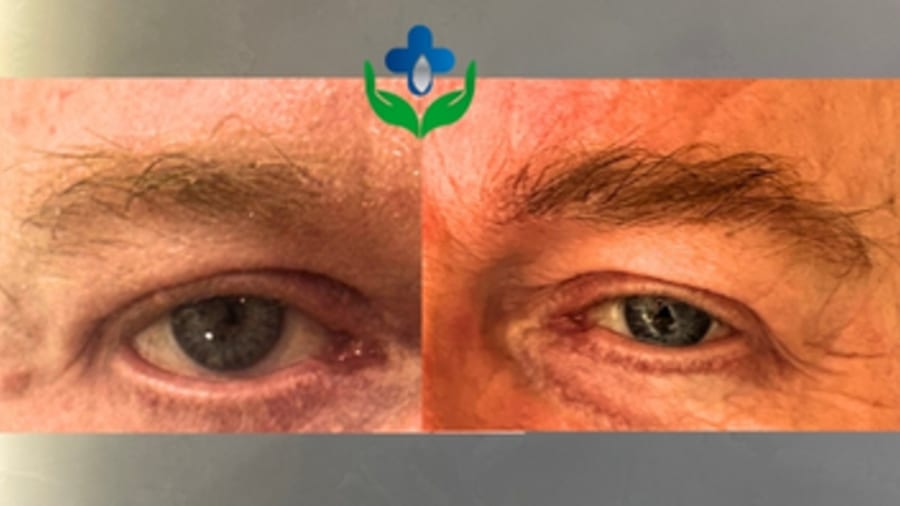 Eyebrow transplant before and after, fuller defined brows on a male patient — Colombia Care, Medellín