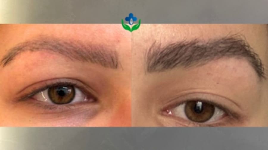 Eyebrow transplant before and after, a fuller and more defined arch — Colombia Care, Medellín