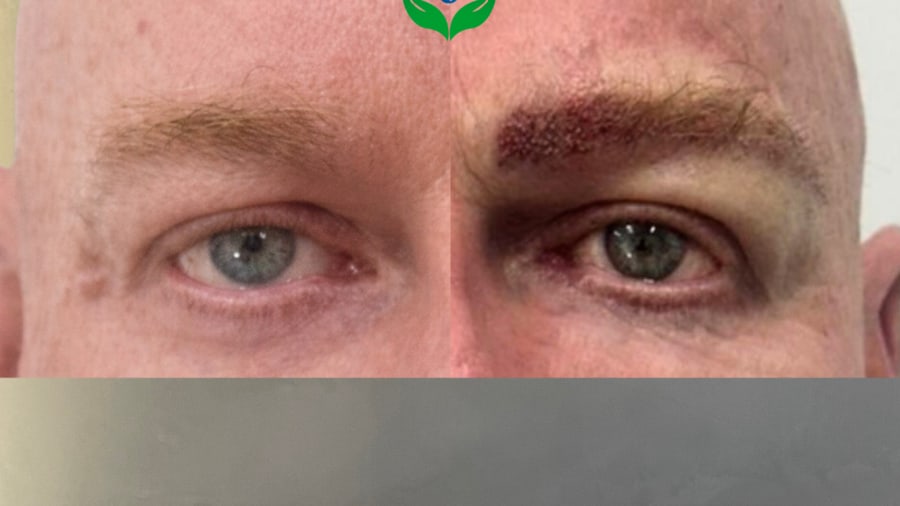 Trasplante de cejas antes y después, cejas más llenas y definidas en un paciente masculino — Colombia Care, Medellín