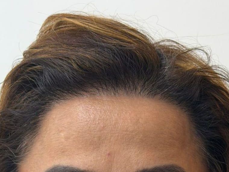 La línea capilar de Janet, completa y más baja, después de su trasplante en Colombia Care, Medellín