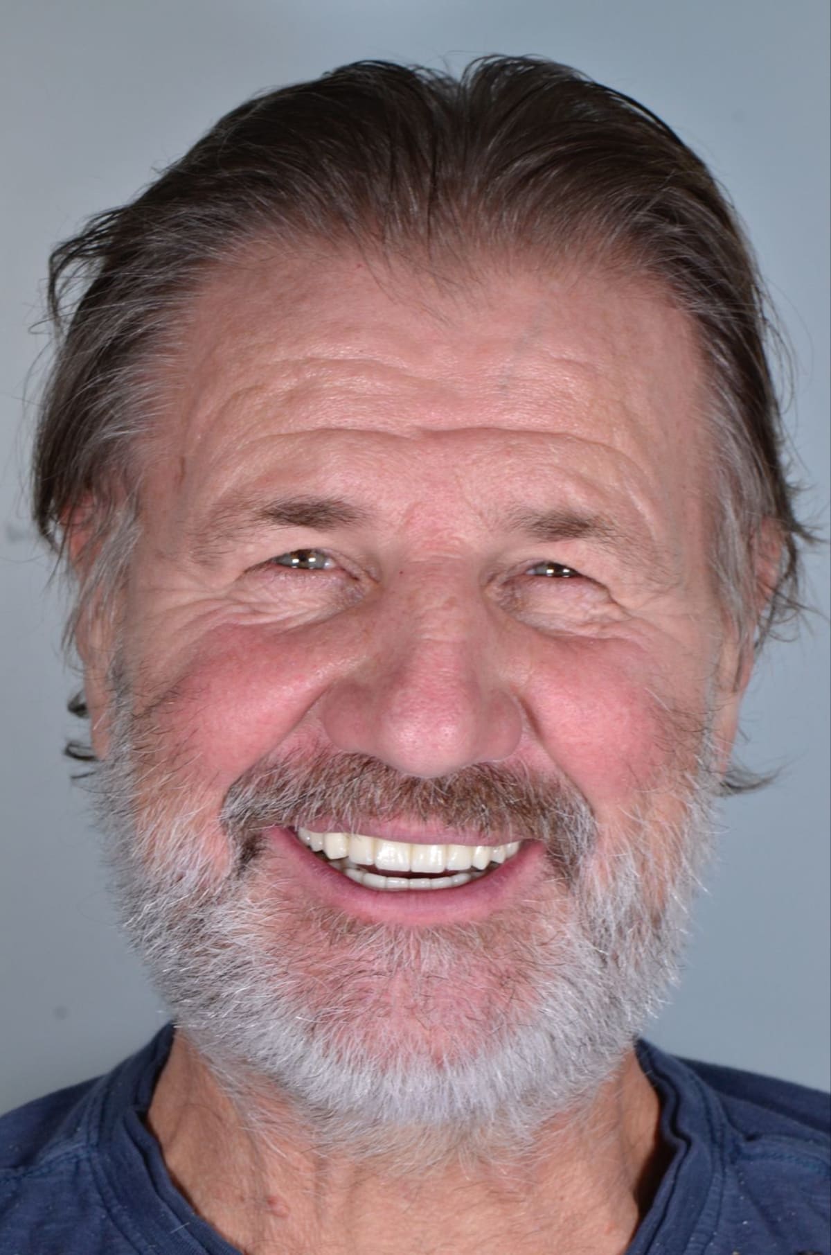 Después, sonrisa restaurada completamente tras implantes All-on-4, Colombia Care Dental, Medellín