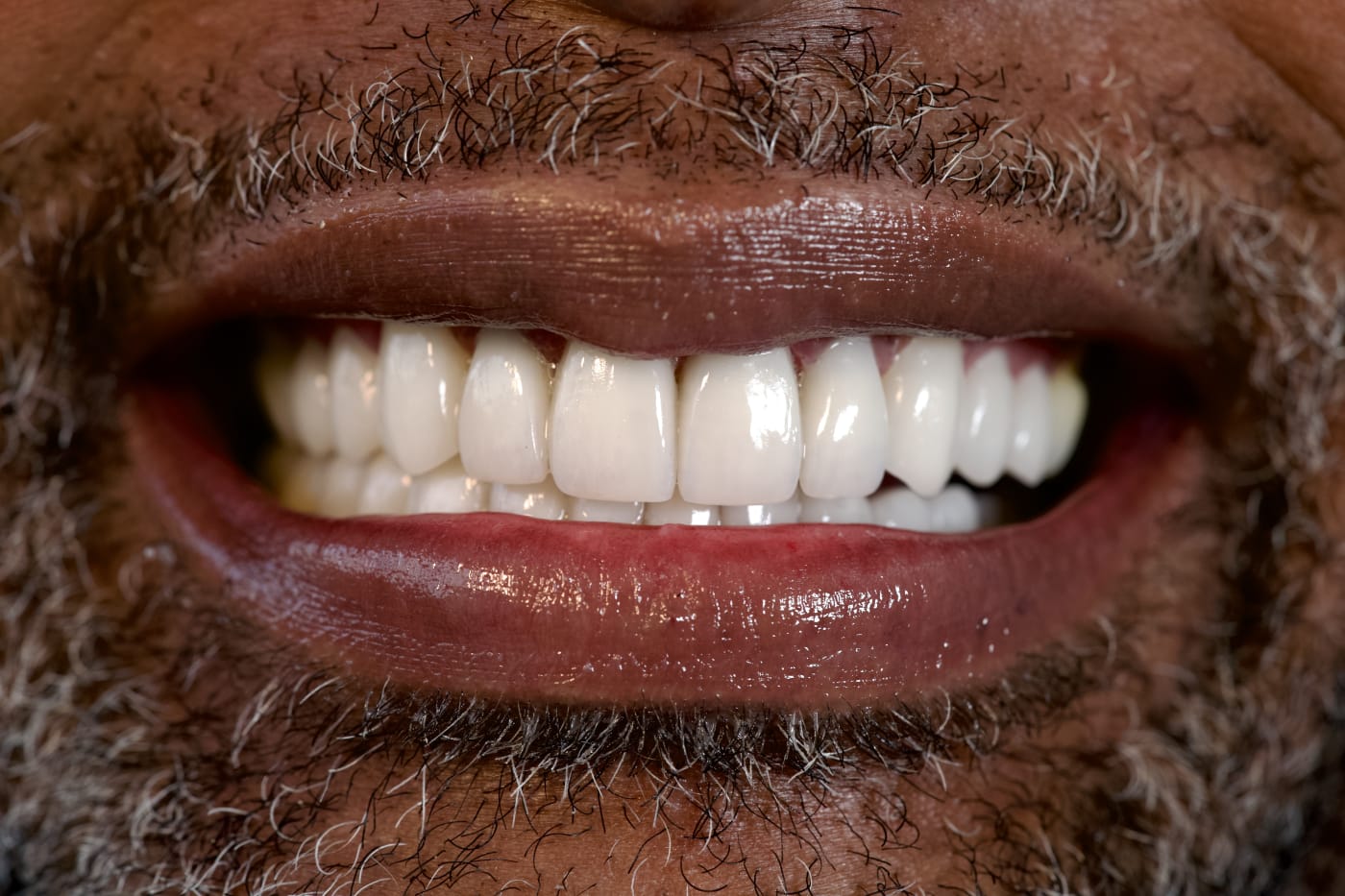 After — restored smile after porcelain veneers, Colombia Care Dental, Medellín