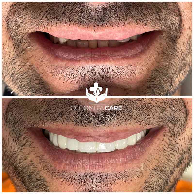 Implante dental antes y después, sonrisa restaurada, Colombia Care Dental, Medellín