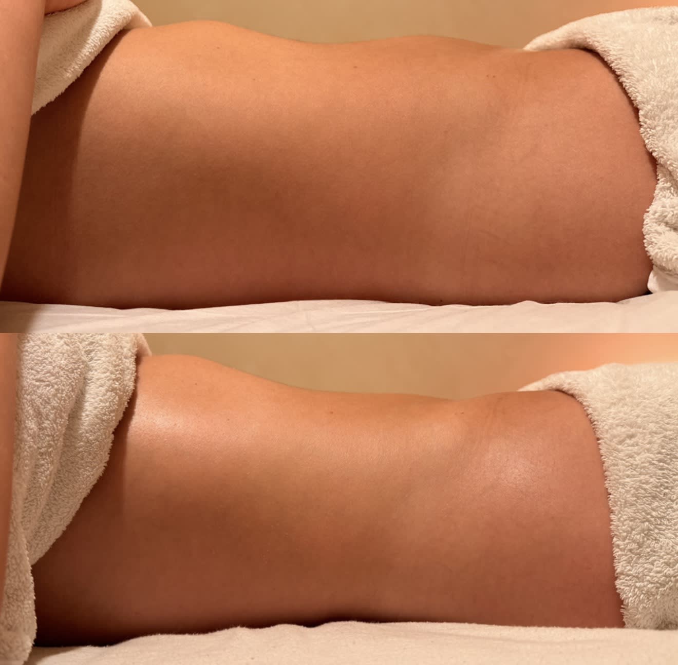 Before and after results of Brazilian lymphatic drainage