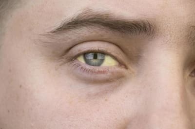 The Medicine Cabinet: Yellow eyes could mean jaundice