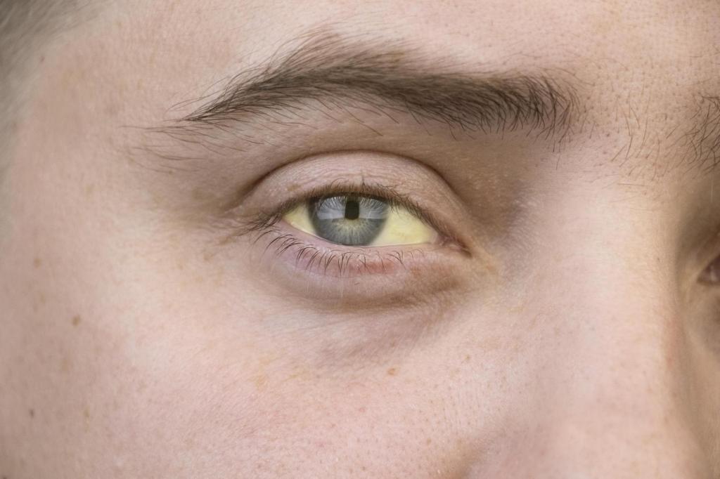 The Medicine Cabinet: Yellow eyes could mean jaundice