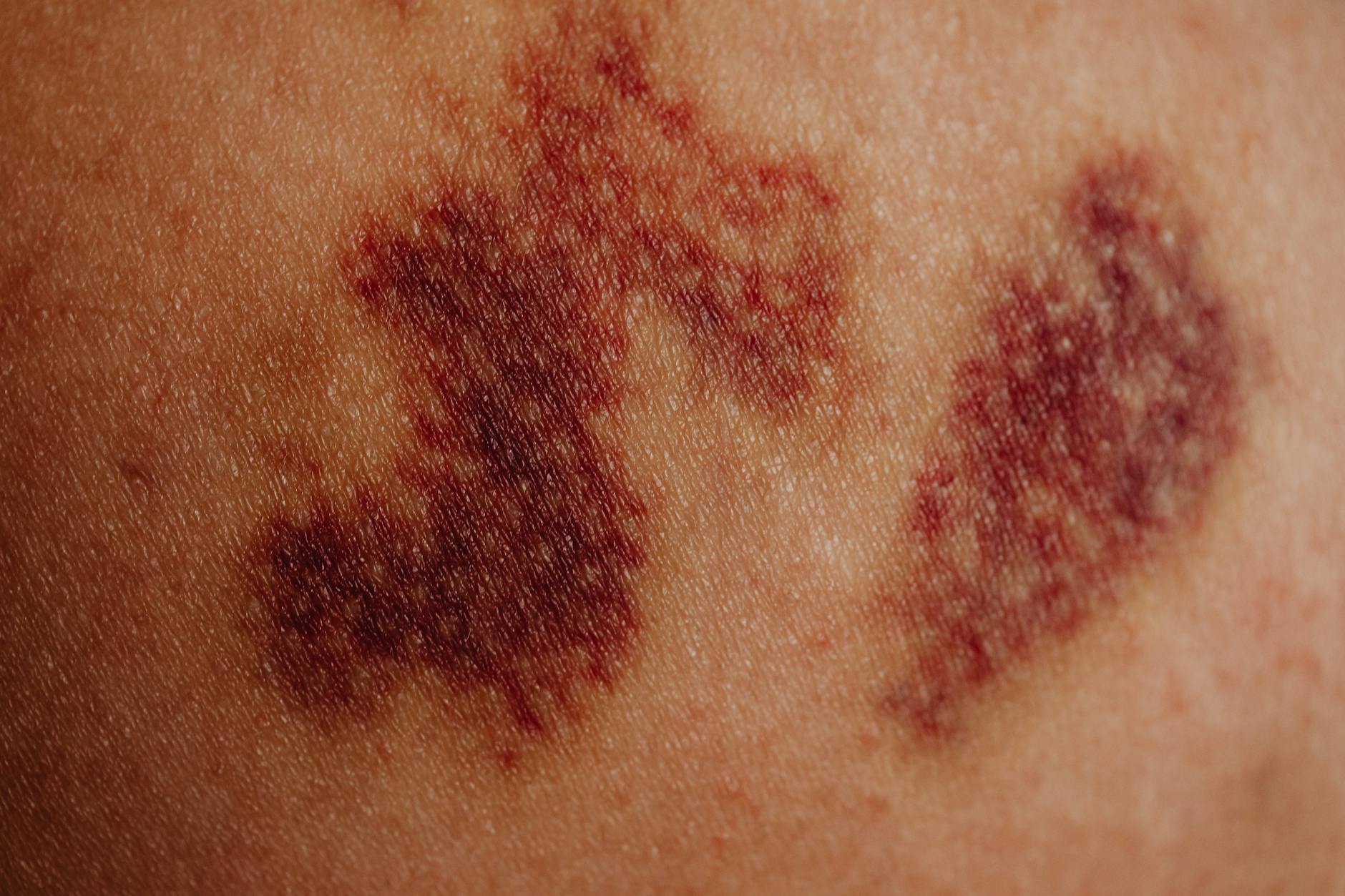 Visible Hand Discoloration Fuels New Health Speculation Ahead of Medical Examination