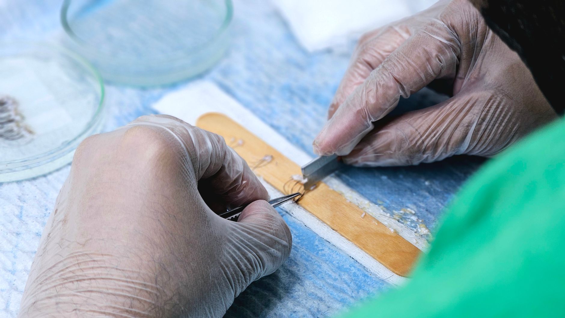 ‘Transformative’ CAR-T therapy allows three people to receive kidney transplants