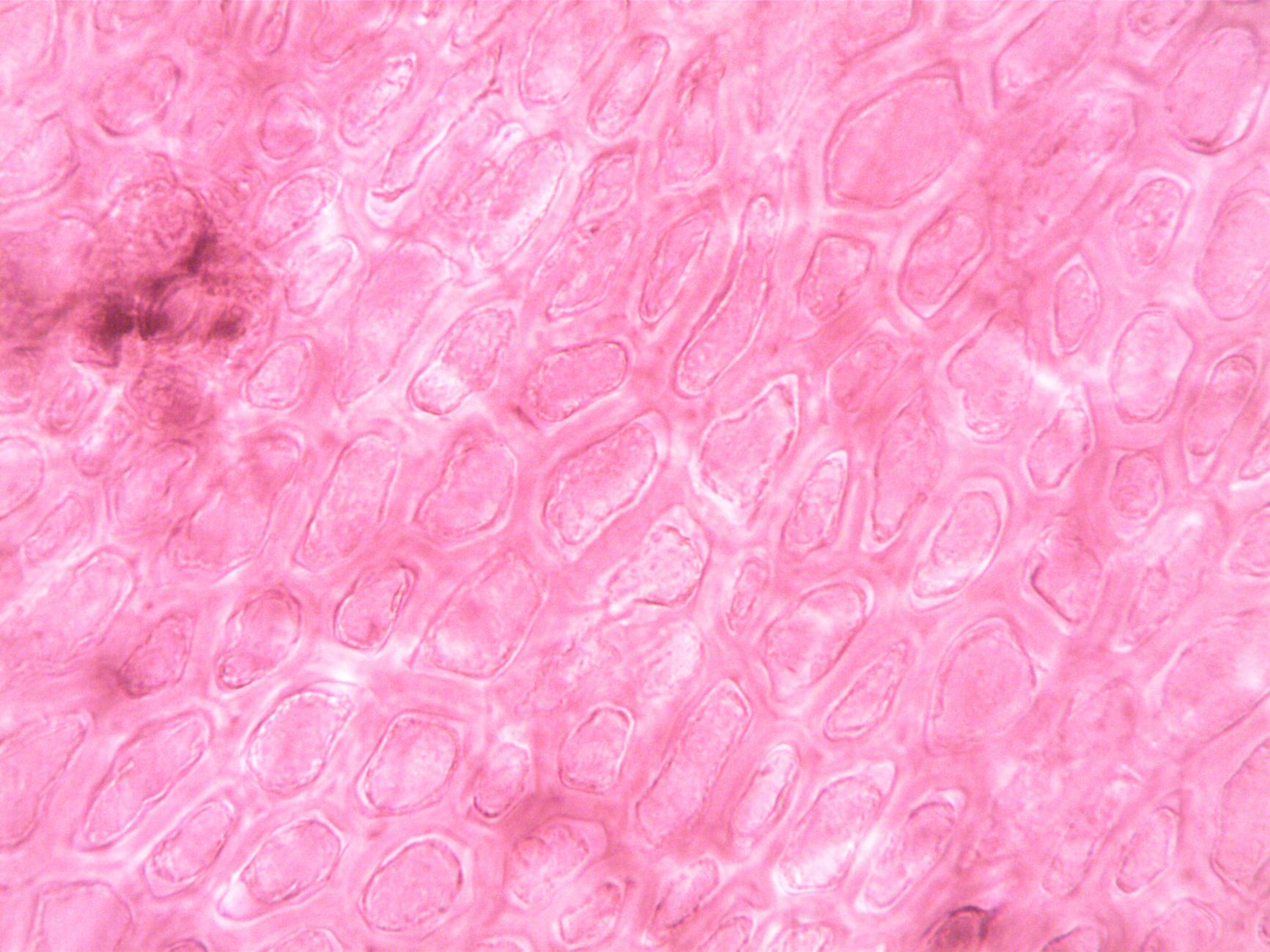Immunotherapy Innovations: Increasing Survival in Metastatic Breast Cancer