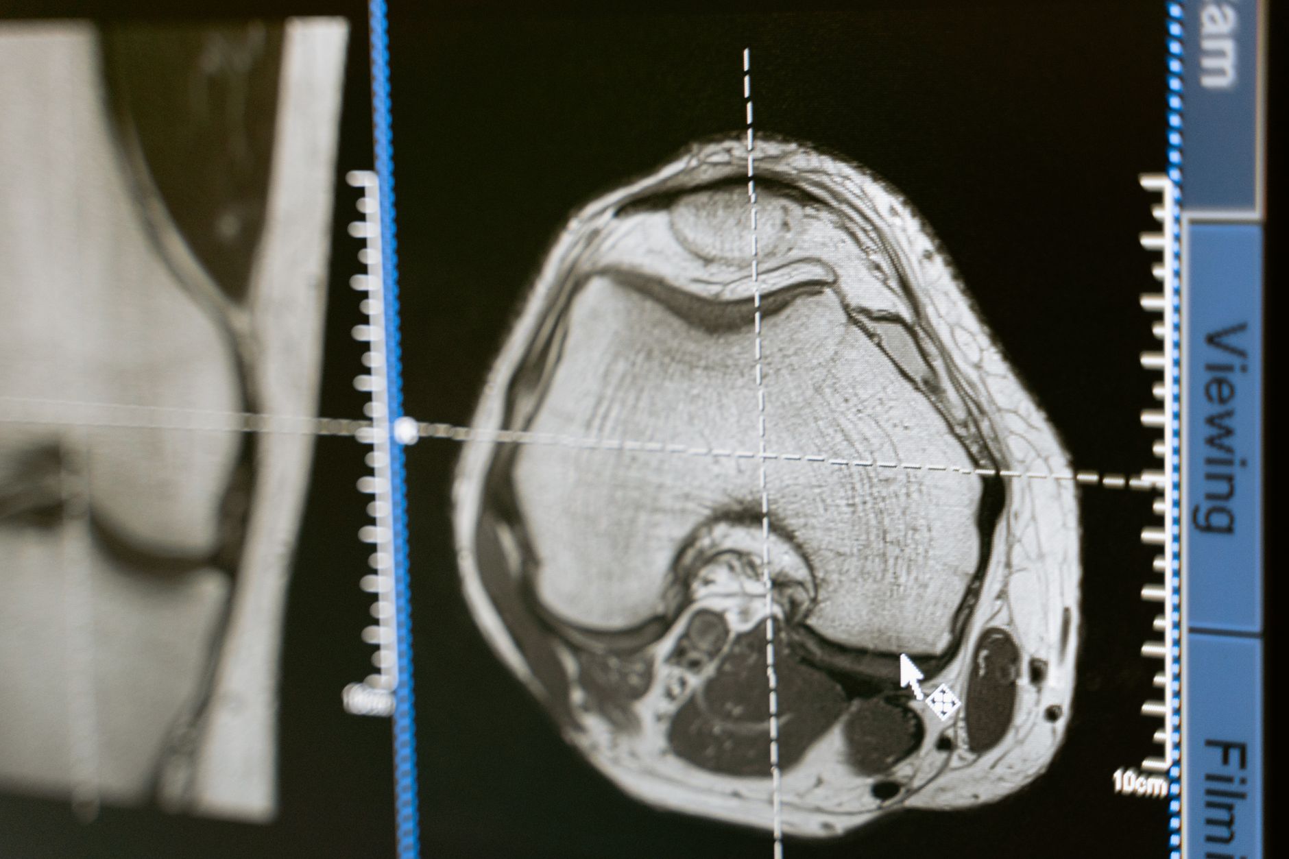 Revolutionary THUNDERBOLT System Secures FDA Clearance, Promising Faster, More Effective Stroke Treatment