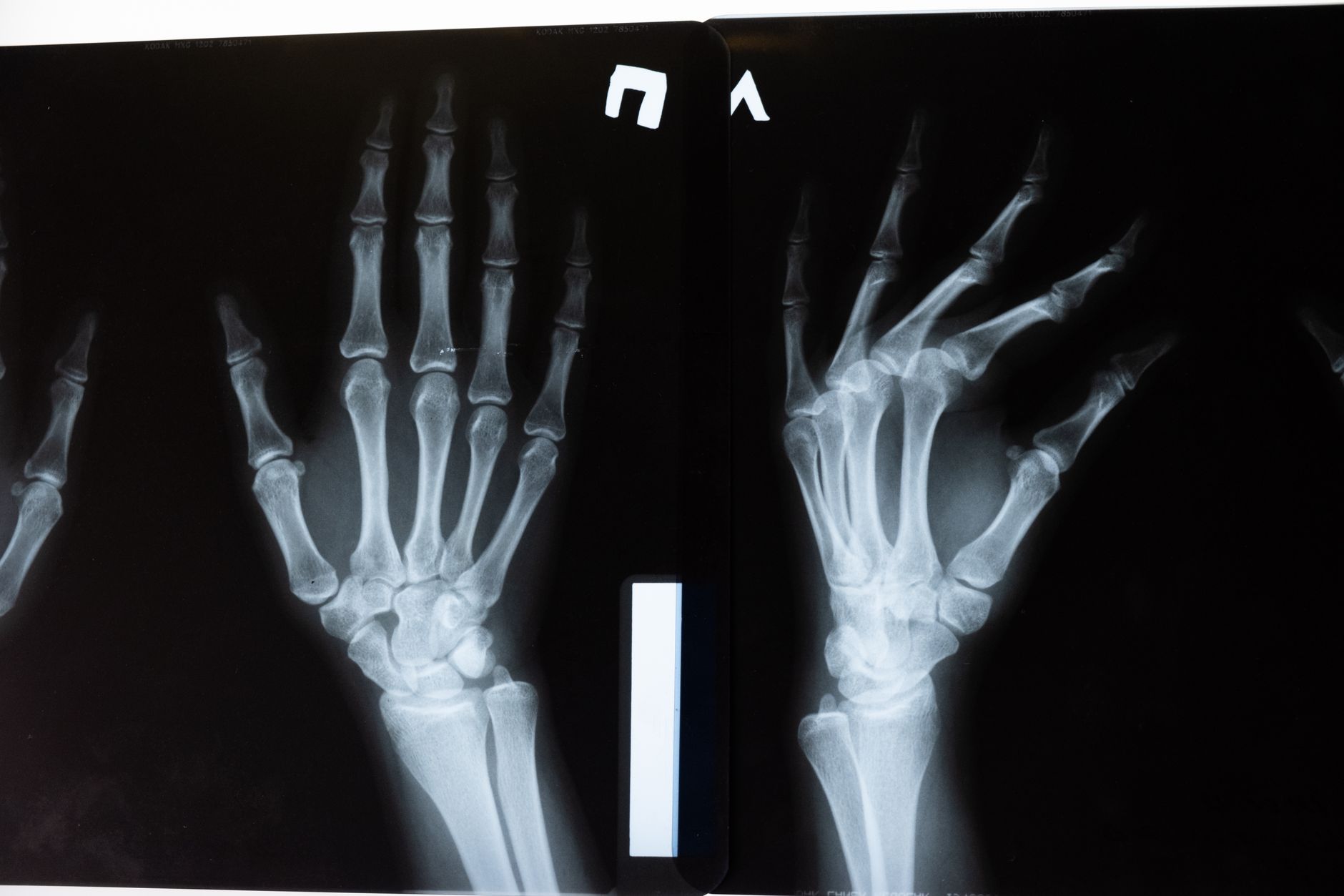 Unlocking the Skeleton's Secrets: New Genomic Map Pinpoints Hundreds of Bone Health Genes