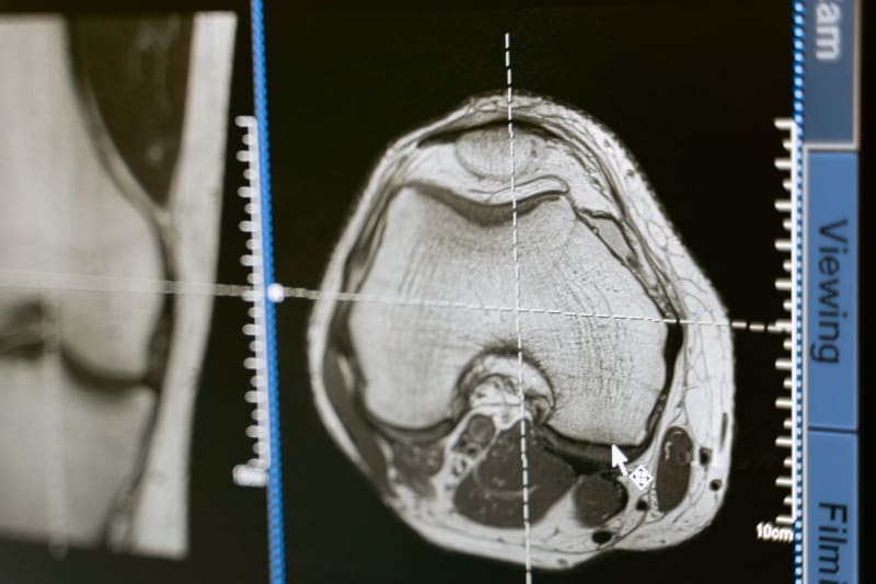 Revolutionary AI System Accelerates Early Detection of Metastatic Breast Cancer, Transforming Patient Prognosis