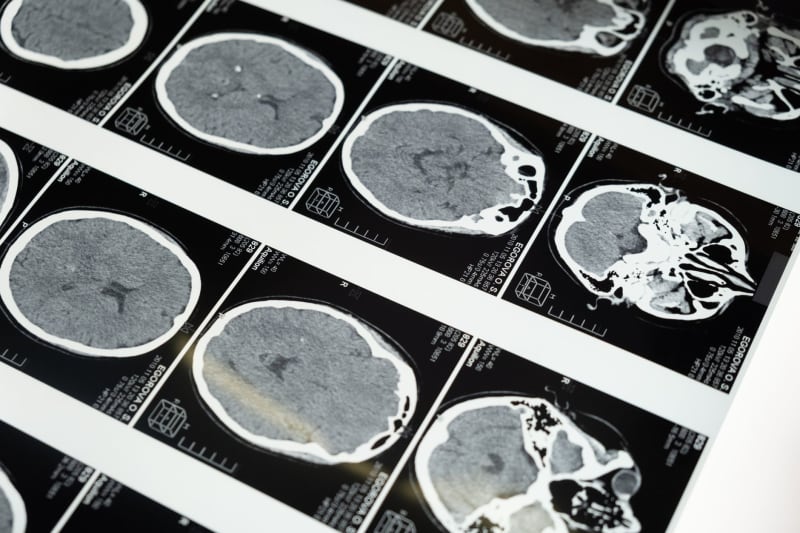 Novel Immunotherapy Strategy Unleashes Dual Attack on Aggressive Brain Tumors and Their Immune Accomplices