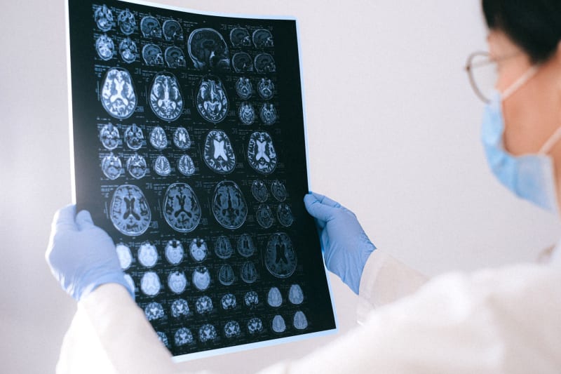 Revolutionary AI Uncovers Hidden MS Lesions on Archival MRI Scans, Transforming Early Diagnosis and Treatment