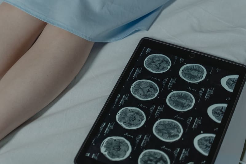 Revolutionary AI Uncovers Hidden MS Lesions on Archival MRI Scans, Transforming Early Diagnosis and Treatment