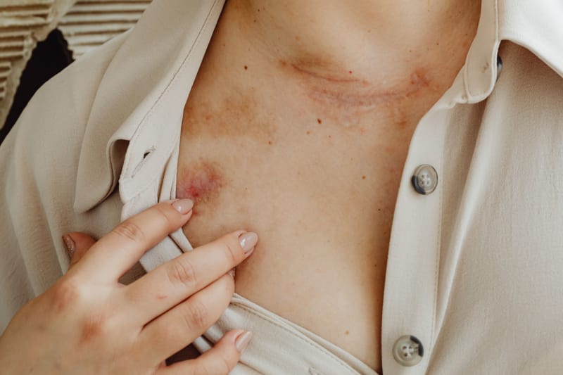 Mexico Grapples with Escalating Leishmaniasis Crisis: A Public Health Emergency Unfolds