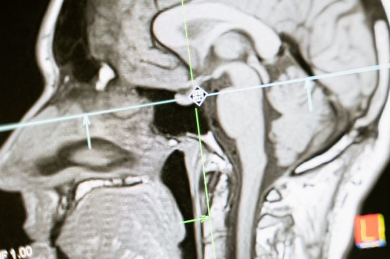Unraveling the Viral Link: Epstein-Barr's Alarming Role in Multiple Sclerosis Development