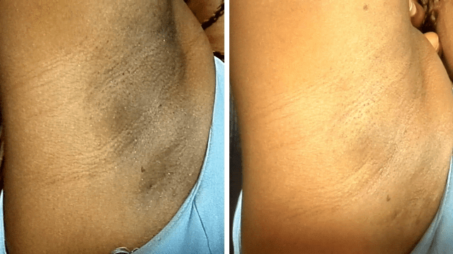 Comparativo real de clareamento nas axilas enviado por cliente