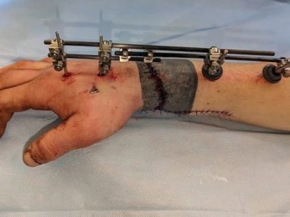 На Кубани хирурги пришили отрубленную руку молодому мужчине