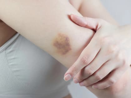 Не игнорируйте: симптомы, которые могут говорить о развитии лейкемии