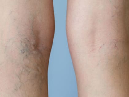 Варикоза не будет: народное средство, которое убирает застойные явления в ногах