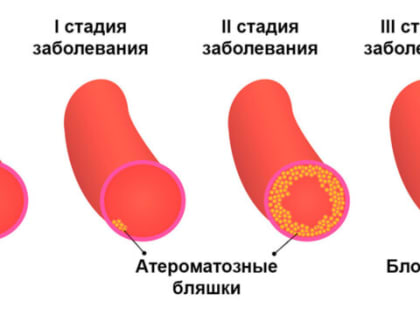 Профилактика атеросклероза: советы кардиолога