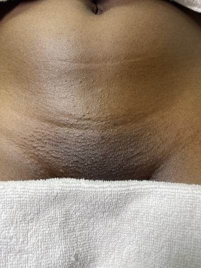 Bikini-line Wax