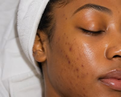 Acne Treatment Facial